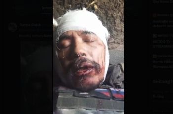 Kepala Penuh Luka Dihantam Drone, Eks Marinir RI yang Jadi Tentara Bayaran Rusia Kini Minta Doa